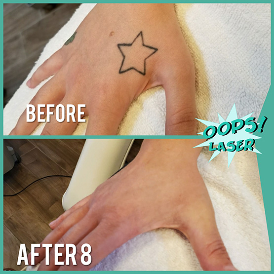 Laser Tattoo Removal – OOPS! Laser